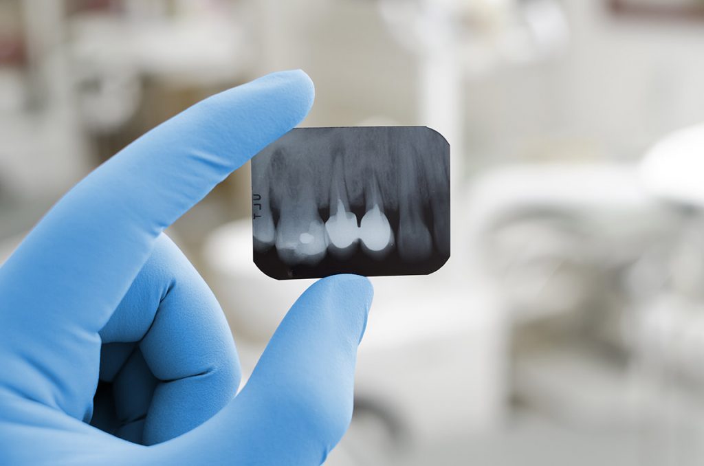 Röntgenbild Zähne